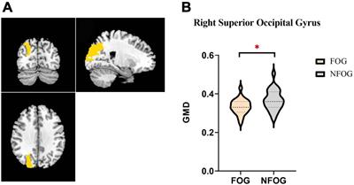 Alterations of structure and functional connectivity of visual brain network in patients with freezing of gait in Parkinson’s disease